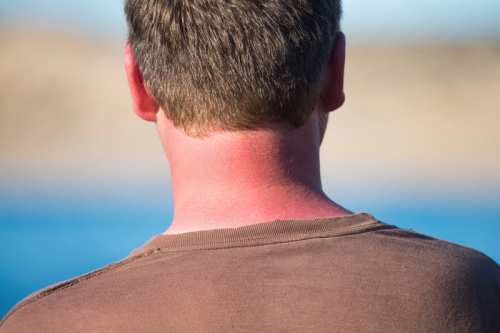 Sunburned neck