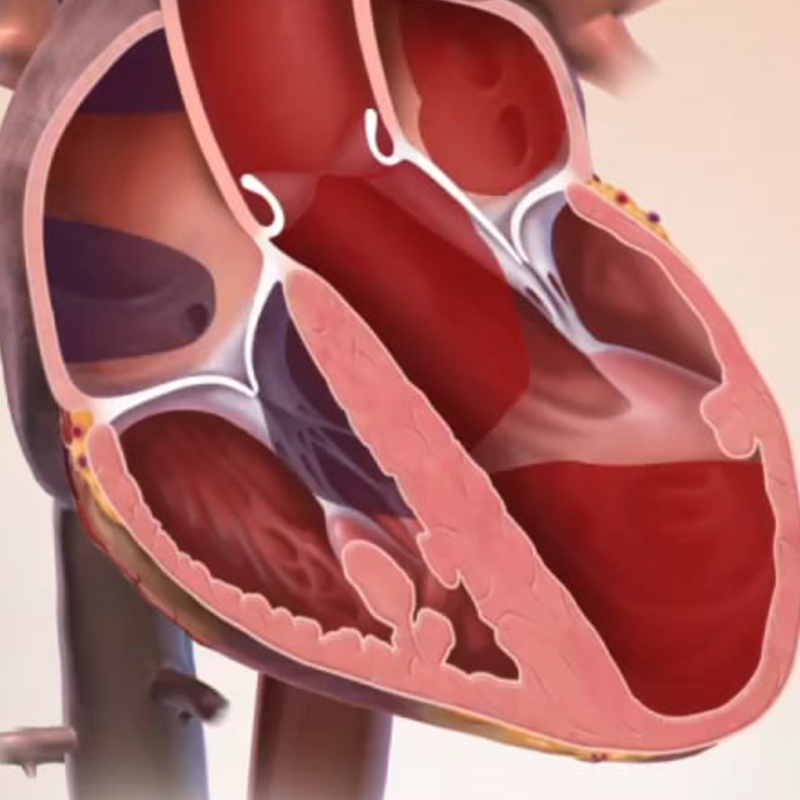 Cardiomyopathy