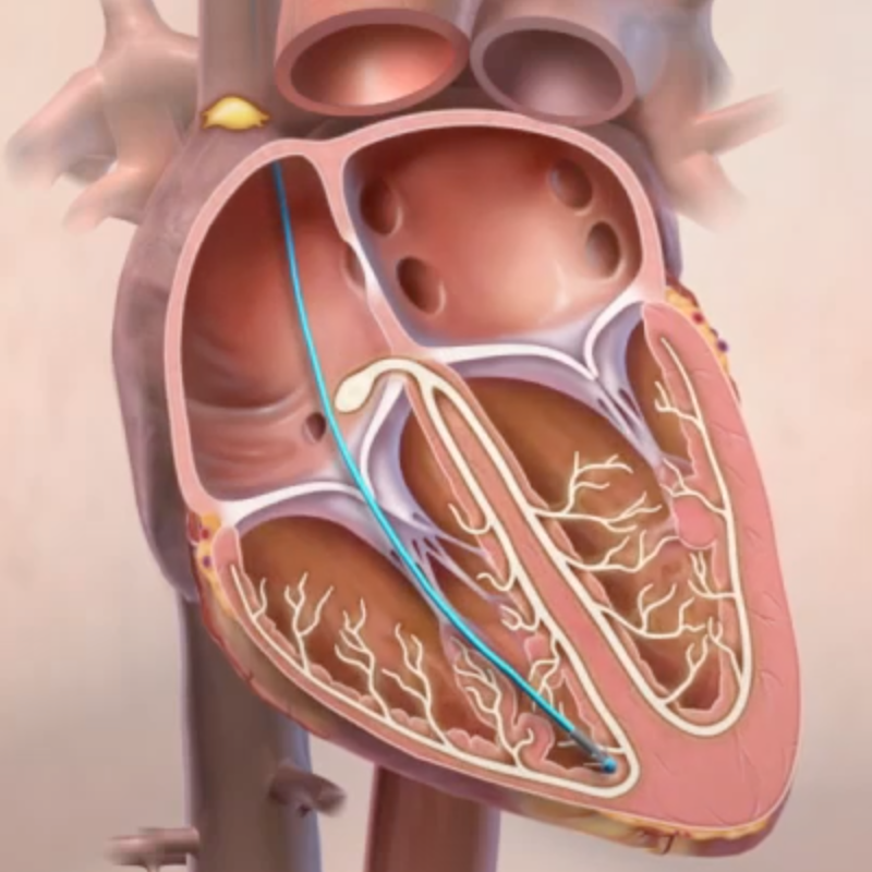 Heart with pacing device