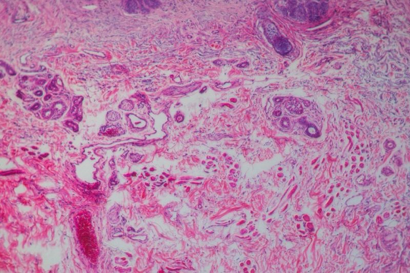Basal Cell Carcinoma (BCC)