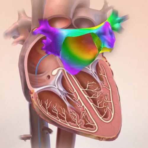 Electrical mapping of the heart