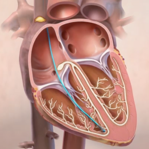 Heart with pacemaker