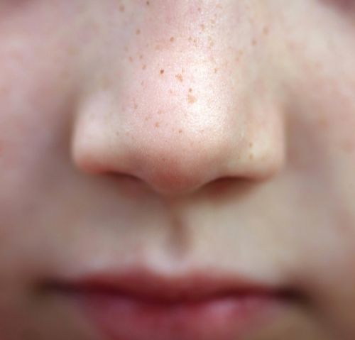 Freckled nose