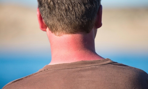 Melanoma, causes & risk factors