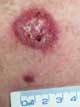 A large Basal cell carcinoma (BCC) on the back with a smaller BCC below it