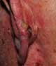 A Squamous cell carcinoma (SCC) on the ear